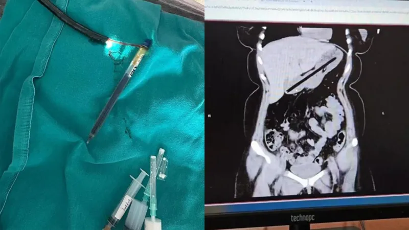 Mideden Çıkanlar Şoke Etti! Doktorlar Bile Hayret Etti